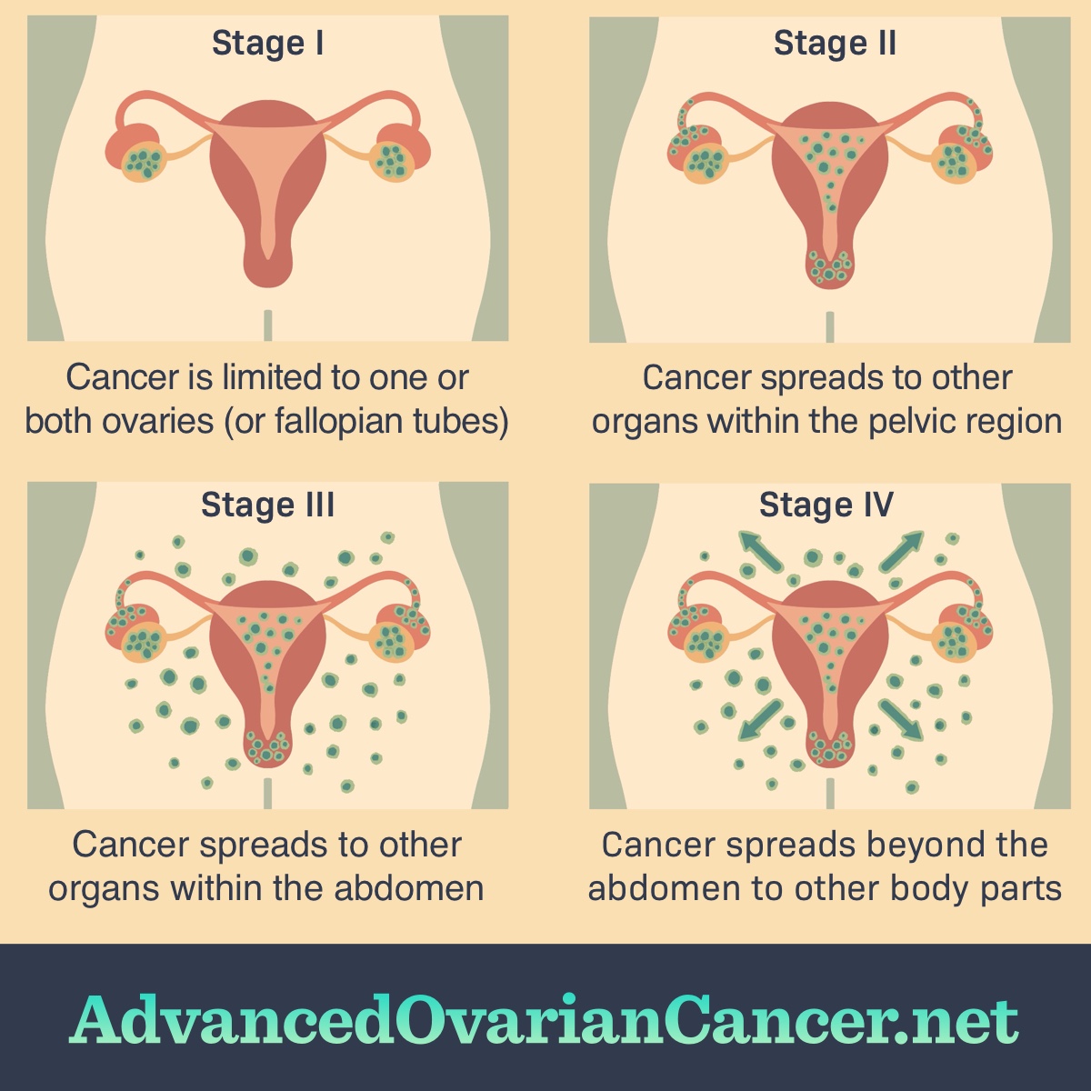 Four stages of ovarian cancer shown from early to late stage in the female reproductive organs.
