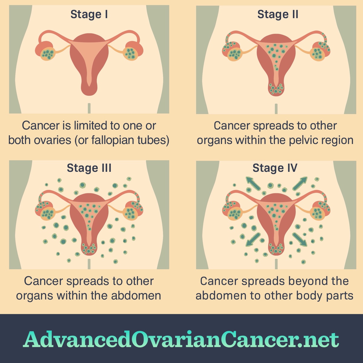 what-are-the-stages-of-ovarian-cancer