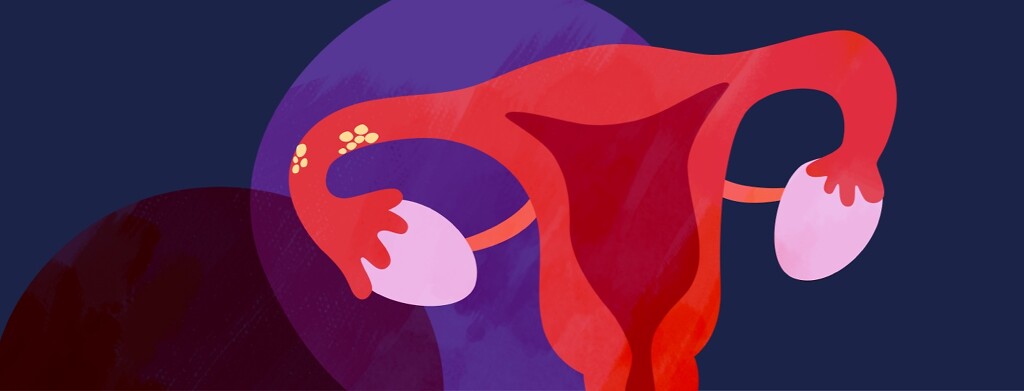 Uterus, showing cancer in the fallopian tube