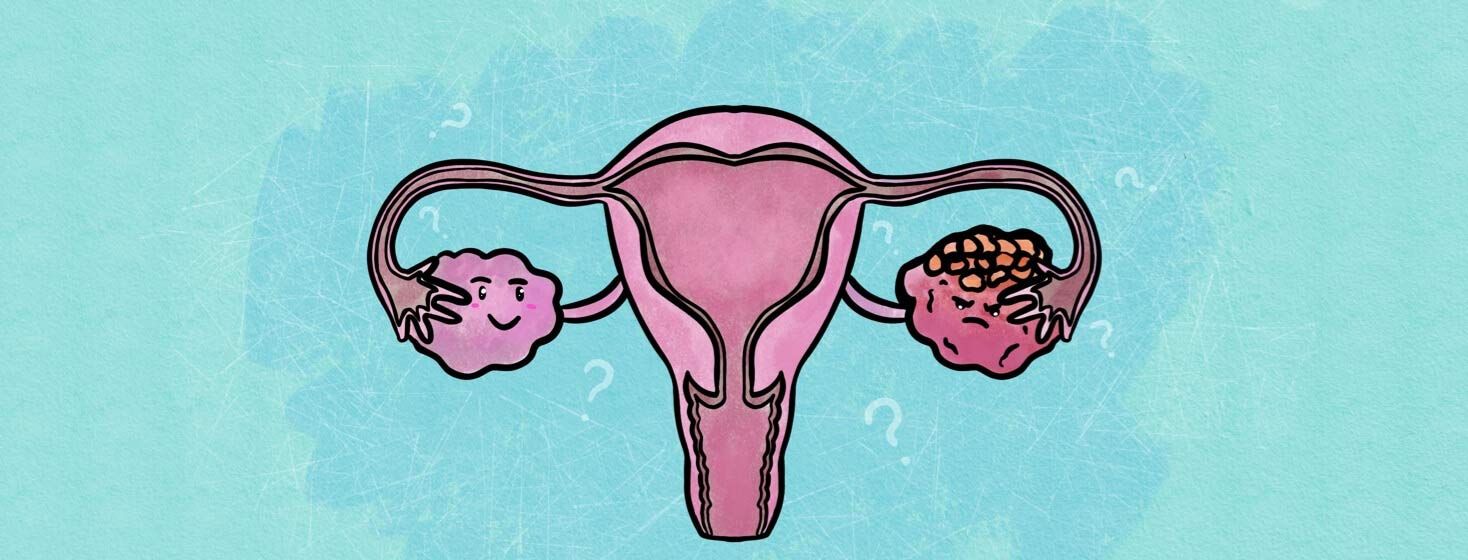 Why is Ovarian Cancer Hard to Detect? image