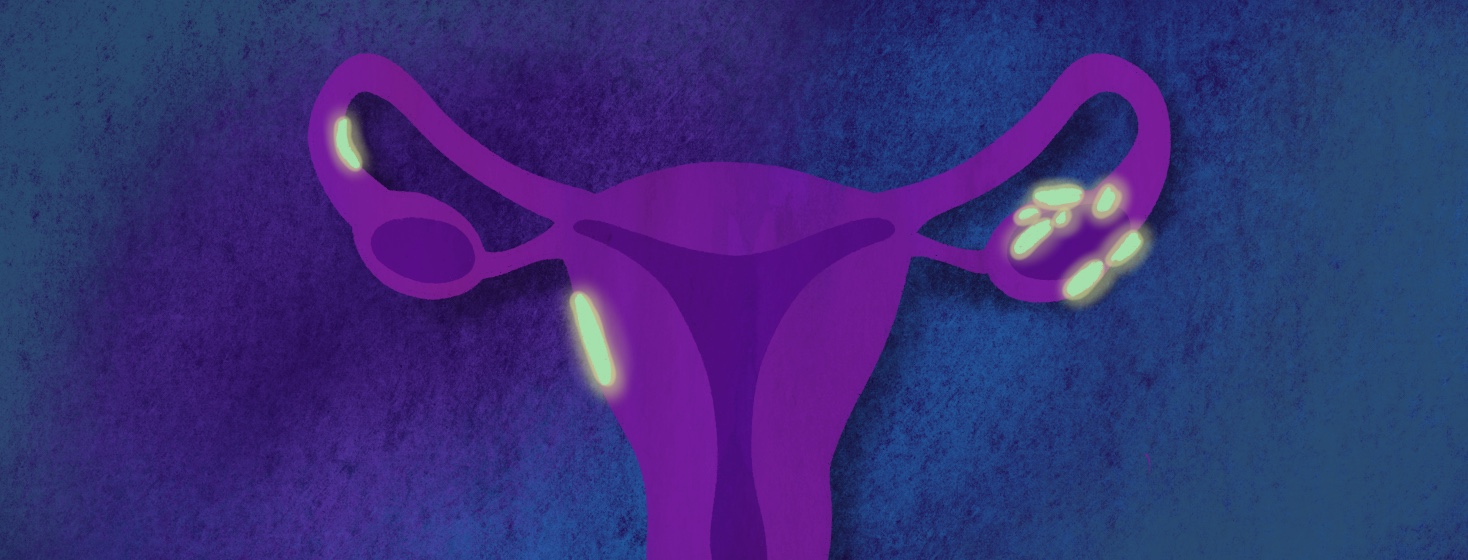 A uterus and ovaries with glowing fluorescent cancerous lesions