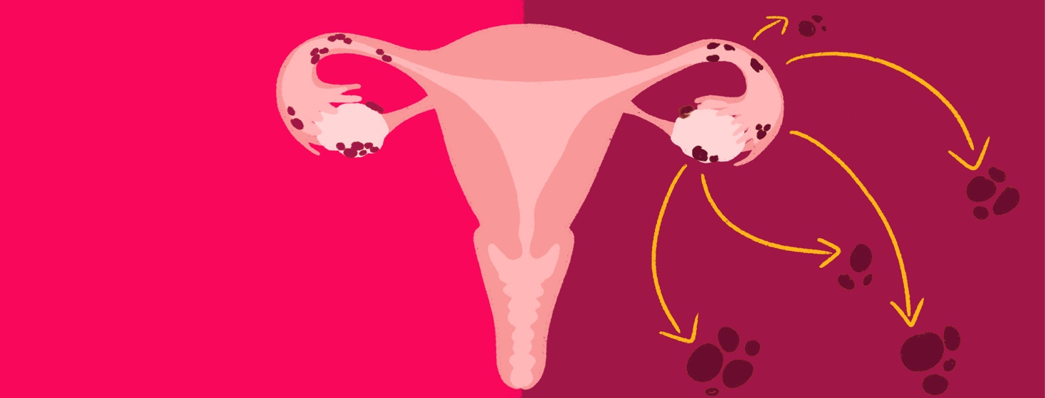 A uterus shows two different kinds of cancer, one isolated to ovaries and fallopian tubes, and one metastasizing to other parts of the body, early stage, late stage